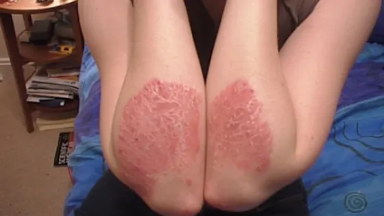 Cel mai bun leac natural pentru psoriazis