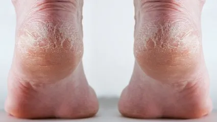 Repară-ţi călcâiele cu acest truc natural!