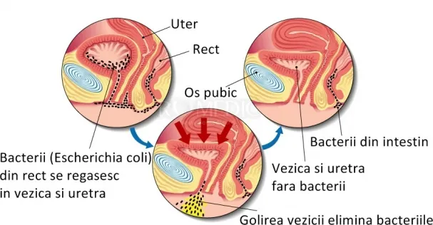 Cum să scapi de infecţia urinară cu acest suc miraculos