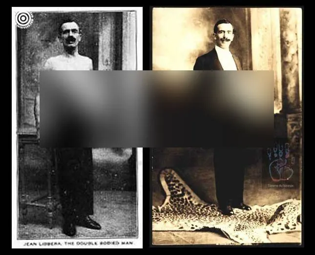 Povestea adevărată a șocat o lume întreagă. Și-a trăit viața cu un frate "parazit" lipit de stomac