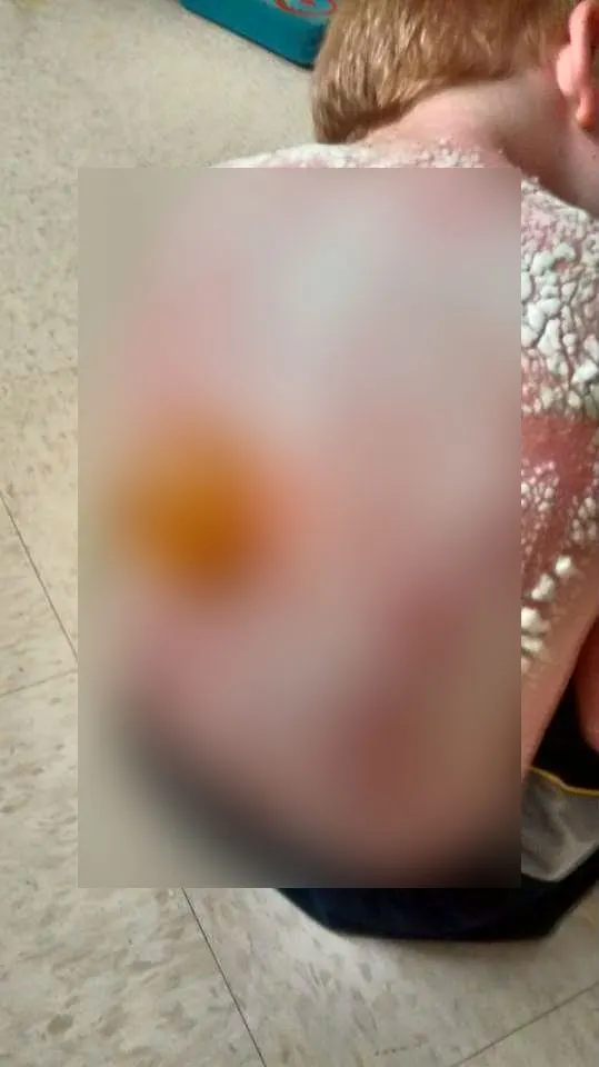 Ce a pățit un copil lăsat fără tricou în plin soare, fără cremă de protecție. Imaginea este șocantă