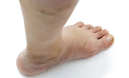 FRESH REFRESH! Cât de grav este să ai picioarele supraponderale