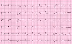 Super veste! Brotac Medical Center are grijă de inima ta! Îți oferă gratuit electrocardiograma!