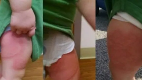 S-a trezit cu erupţii ciudate pe piele. Motivul? O greşeală pe care toţi o facem