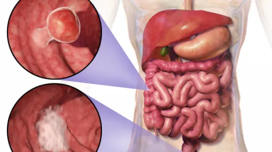 5 simptome comune ale cancerului colorectal