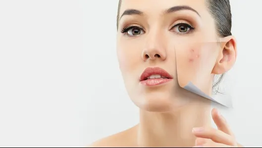 Tratamentul natural ieftin, în doi pași, prin care scapi de punctele negre
