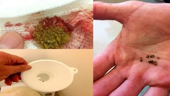 Remediul miraculos care îţi curăţă rinichii! Nu vei mai avea niciodată probleme cu pietrele