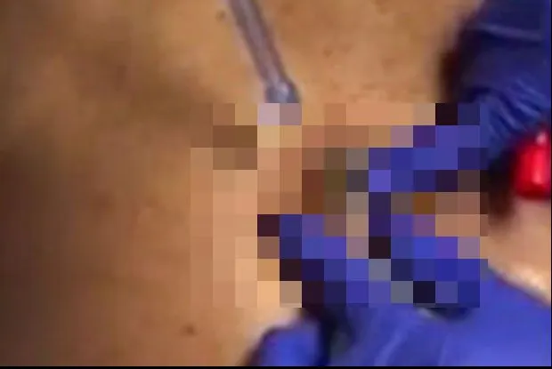 Și-a spart un chist de pe spate și l-a strâns cu putere!A rămas fără cuvinte când a ieșit ”monstrul”