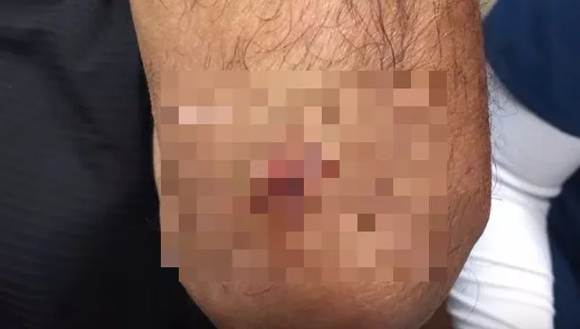 Avea o umflătură sub cot. S-a dus la medic să i-o spargă. A leșinat când a văzut ce iese din ea