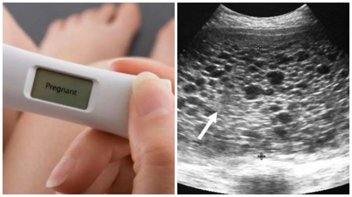 Testul a arătat că e însărcinată și era fericită. La prima ecografie, medicul s-a îngrozit