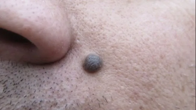 Cum scapi de alunițele inestetice cu acest ingredient banal. Efectele se văd după doar 5 zile