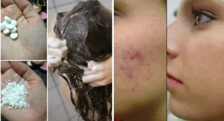 Remediul ieftin pe care şi tu îl ai în casă: tratează acneea şi te scapă de mătreaţă