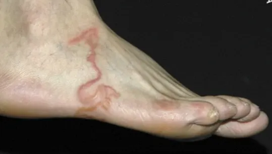 Credea că are varice şi s-a dus la doctor. Ce era, de fapt, "vena" inflamată. E şocant!