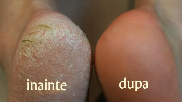 Cum să-ţi cureţi călcâiele cu bicarbonat de sodiu
