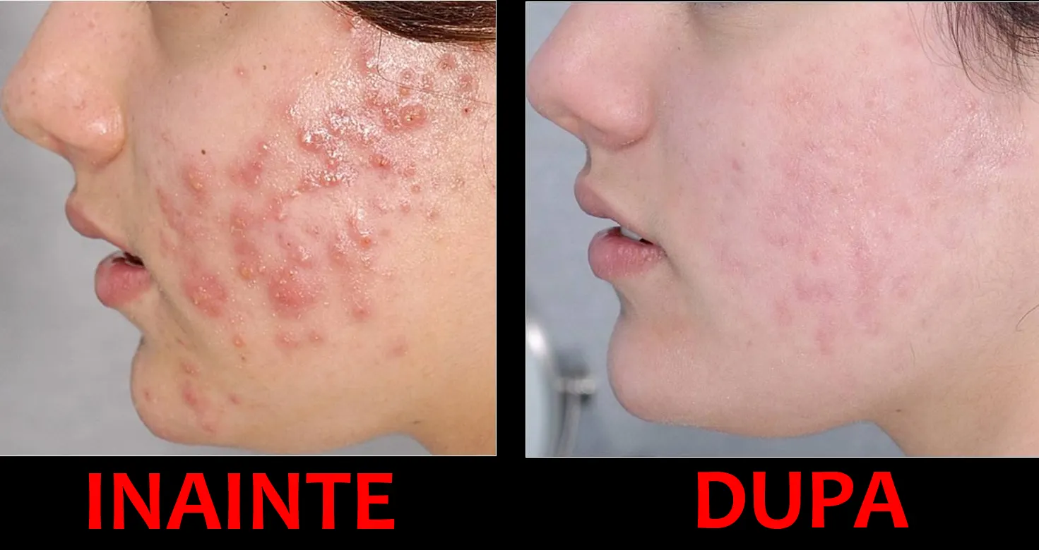 Scapă de coșuri cu acest tratament anti-acnee