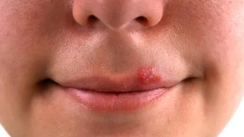 Acest leac te va scăpa herpes pentru totdeauna. Ai nevoie doar de un ingredient!