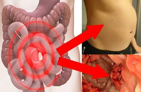 Simptomele cancerului de colon, boala care afectează una din 20 de persoane