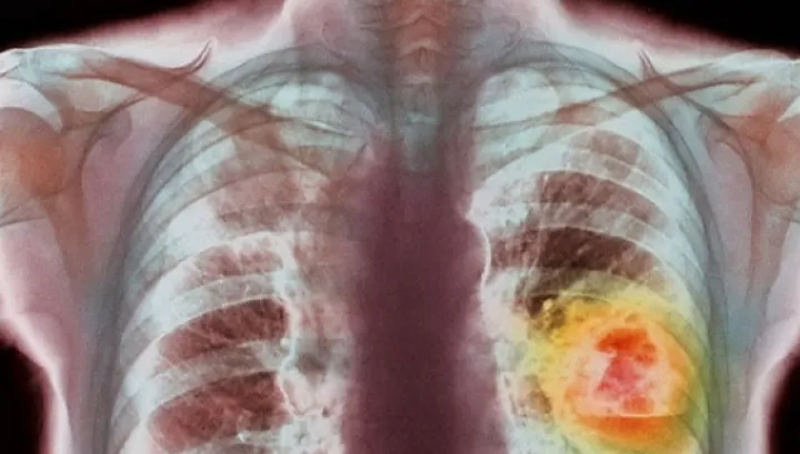 Descoperire medicală. Acesta este alimentul care ucide 85% din celulele cancerului pulmonar
