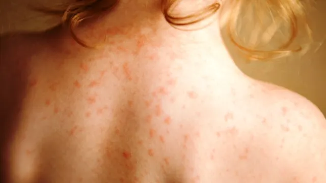 FRESH REFRESH. Nu neglijați dermatita atopică, boala care îi afectează și pe copii, și pe adulți