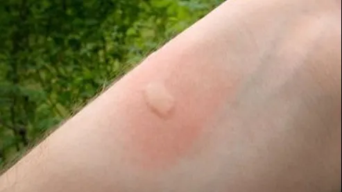 Te-a muşcat un ţânţar? Iată ce trebuie să faci pentru a scăpa de mâncărime. E simplu!