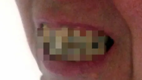 Îi este ruşine să mai iasă din casă după ce a observat ce îi creşte în gură! Medicii au fost şocaţi