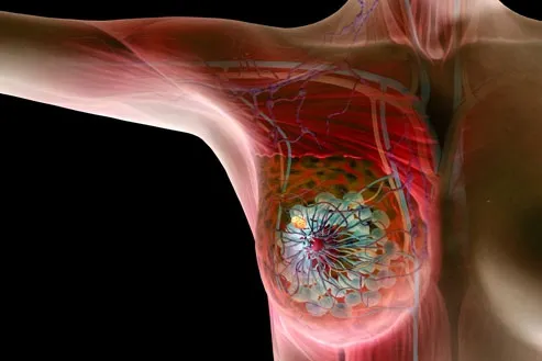 5 simptome timpurii ale cancerului. Probabil nu le-ai observat