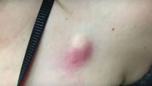 S-a trezit cu o mică înțepătură, însă în 2 zile s-a transformat complet. Când a mers la doctor. ȘOC