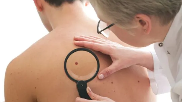 Ai aluniţe roşii? Mare atenţie! Mergi de urgenţă la medic dacă...