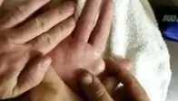 Prietenul lor dormea, iar ei i-au spart chistul de pe mână. Ce a ieşit de acolo i-a ÎNGROZIT
