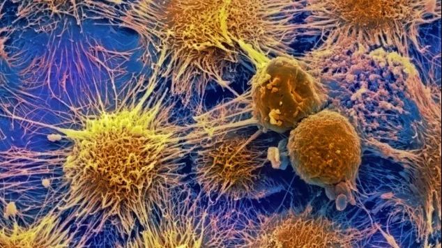S-au descoperit cauzele cancerului. Lista factorilor care duc la apariția lui