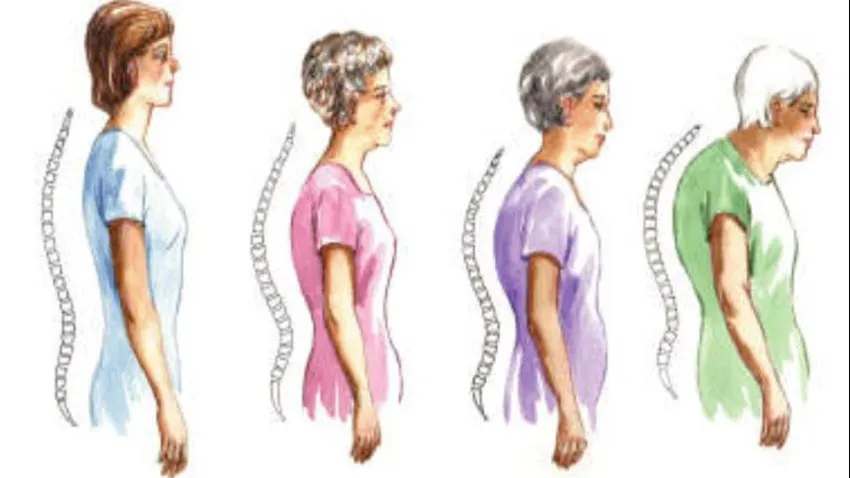 Cum prevenim osteoporoza cel mai simplu