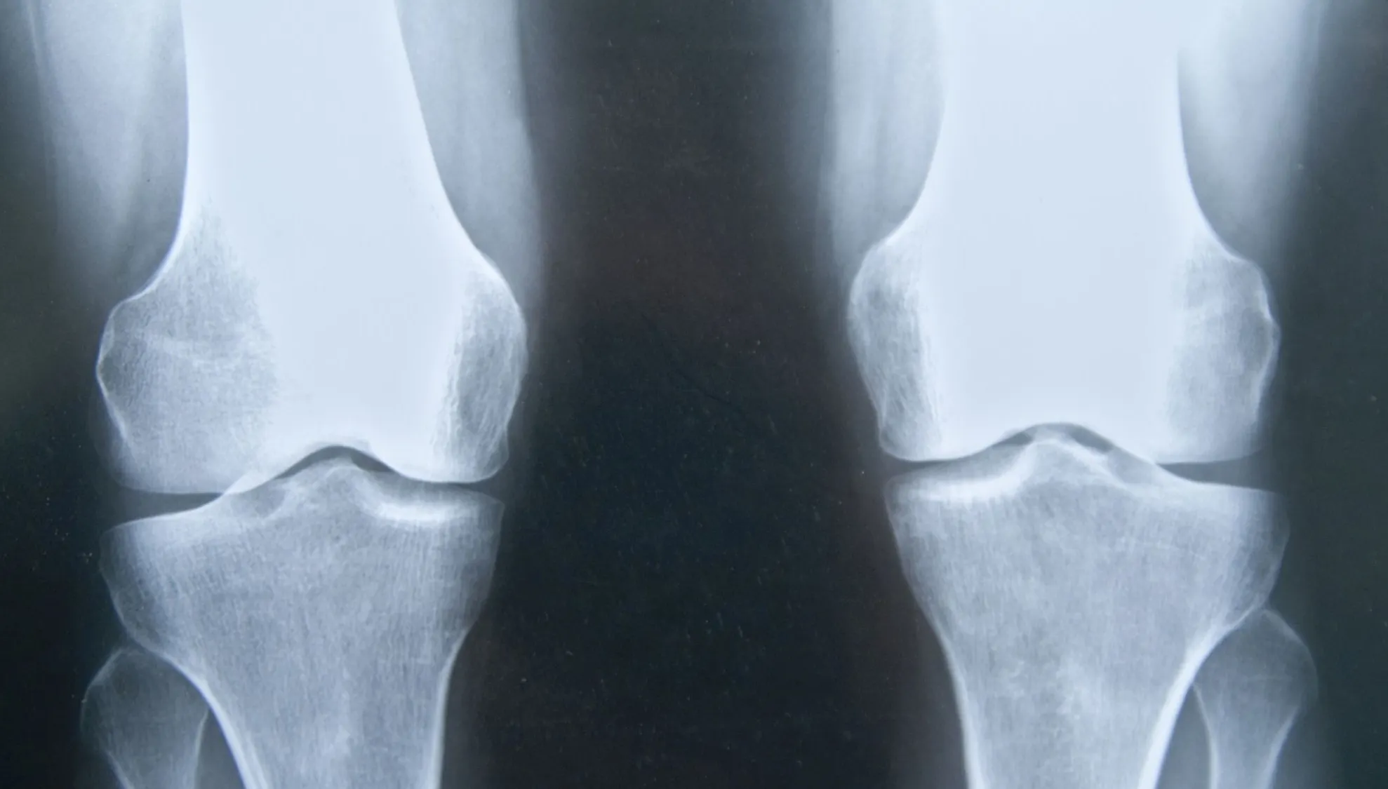 Ai probleme cu articulațiile? Verifică sistemul endocrin!