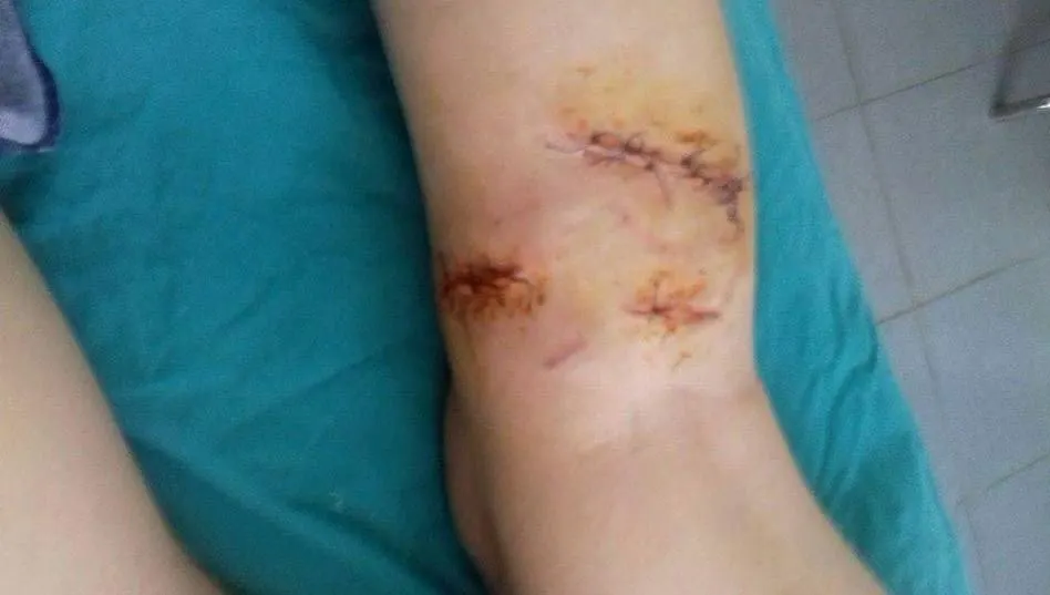 Copil de urgenţă la spital după ce a fost muşcat de 7 câini, pe stradă, în Sibiu