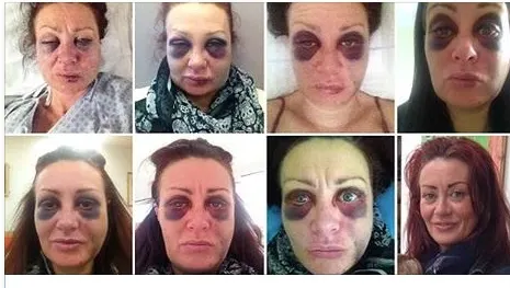 Curajul de a înfrunta violenţa domestică. Femeia şi-a fotografiat în fiecare zi vânătăile cu un scop