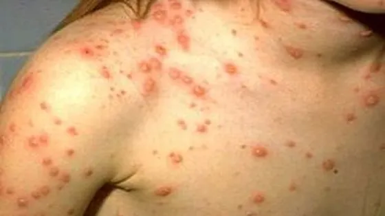 Zece cazuri noi de rujeolă confirmate în Vaslui. În toate cazurile, copiii nu au fost vaccinaţi
