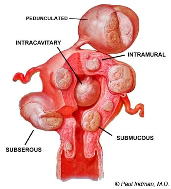 Fibromul uterin. Simptomele care ar trebui să alarmeze femeile. Durerea de spate, una dintre ele