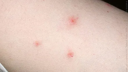 Patru insecte care te pot ucide cu înţepăturile lor! Mergi de urgenţă la medic dacă îţi apar semne