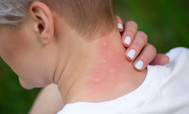 Cum să tratezi acasă înțepăturile de insecte. Uite cât de simplu e