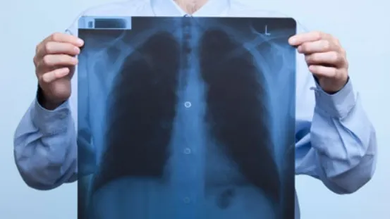 Aşa arată plămânii după doar două pachete de ţigari! Imagini terifiante