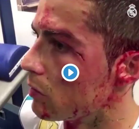 Imagini crunte cu Cristiano Ronaldo, accidentat