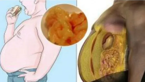 Aceasta este cea mai PERICULOASĂ grăsime din organism