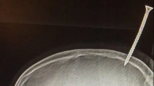 Caz medical înfricoșător: Un șurub de 15 cm a perforat creierul unui băiat de 13 ani