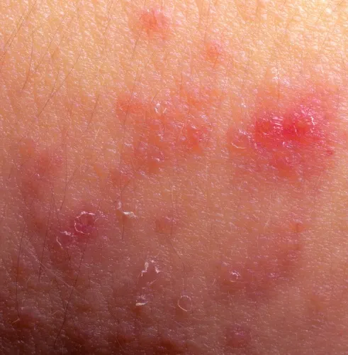 Dermatita atopică. Cauzele nebănuite prin care pielea poate arăta aşa
