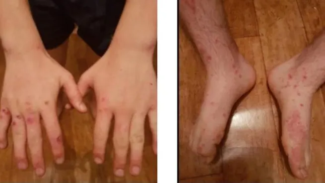 Medicii sunt şocaţi: Tânăr infectat cu virus dispărut în urmă cu 300 de ani