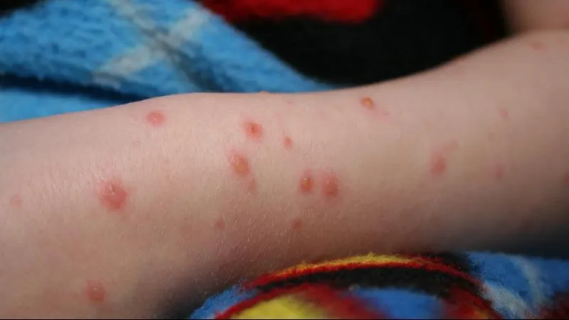 Explozie de cazuri de rujeolă, în România! 800 de noi îmbolnăviri, într-o singură lună: avertismentul medicilor/ Arhivă foto