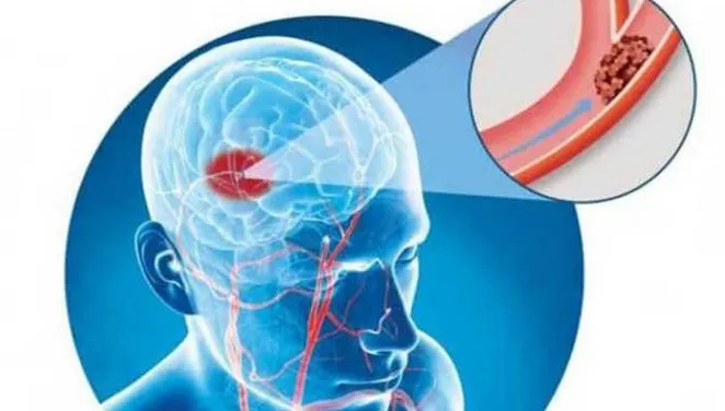 Semne ale atacului cerebral care apar cu mult ÎNAINTE de declanşare. Nu le ignora!