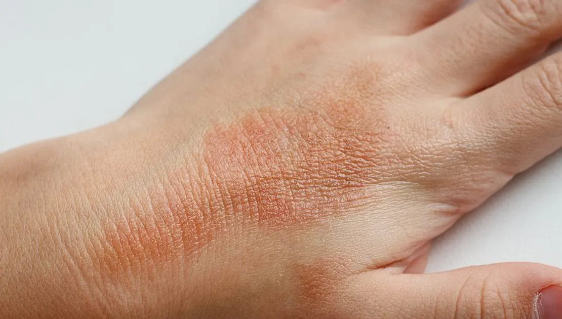 Dermatita atopică: simptome și cauze
