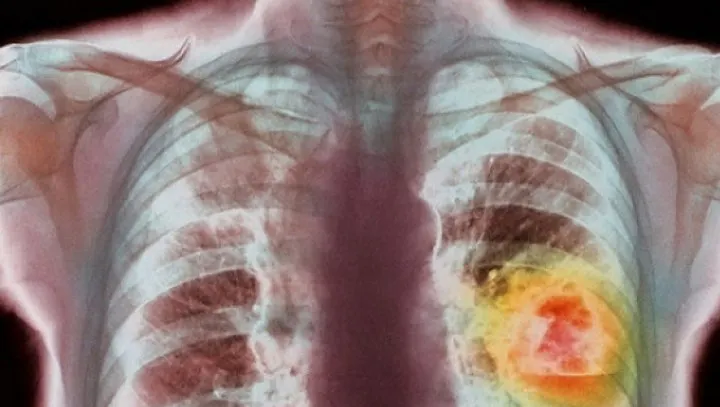 Dacă ai aceste simptome, multă grijă: ar putea fi cancer pulmonar