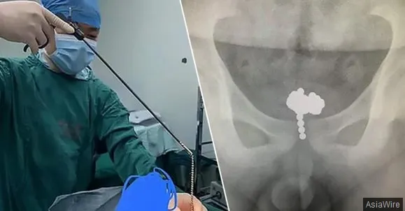 Copilul a ajuns la spital cu dureri mari! I-au scos 70 de bile din zona intimă. Gestul care a șocat
