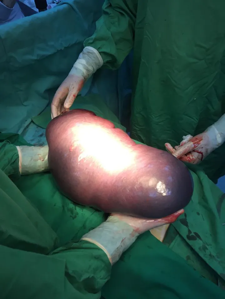 Medicii au decis să îi scoată splina. În timpul operației au avut un ȘOC. Are peste 6 kg!